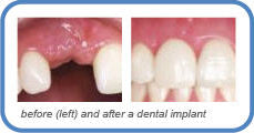 Dental Implants
