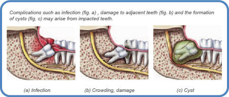 Wisdom Teeth Extractions