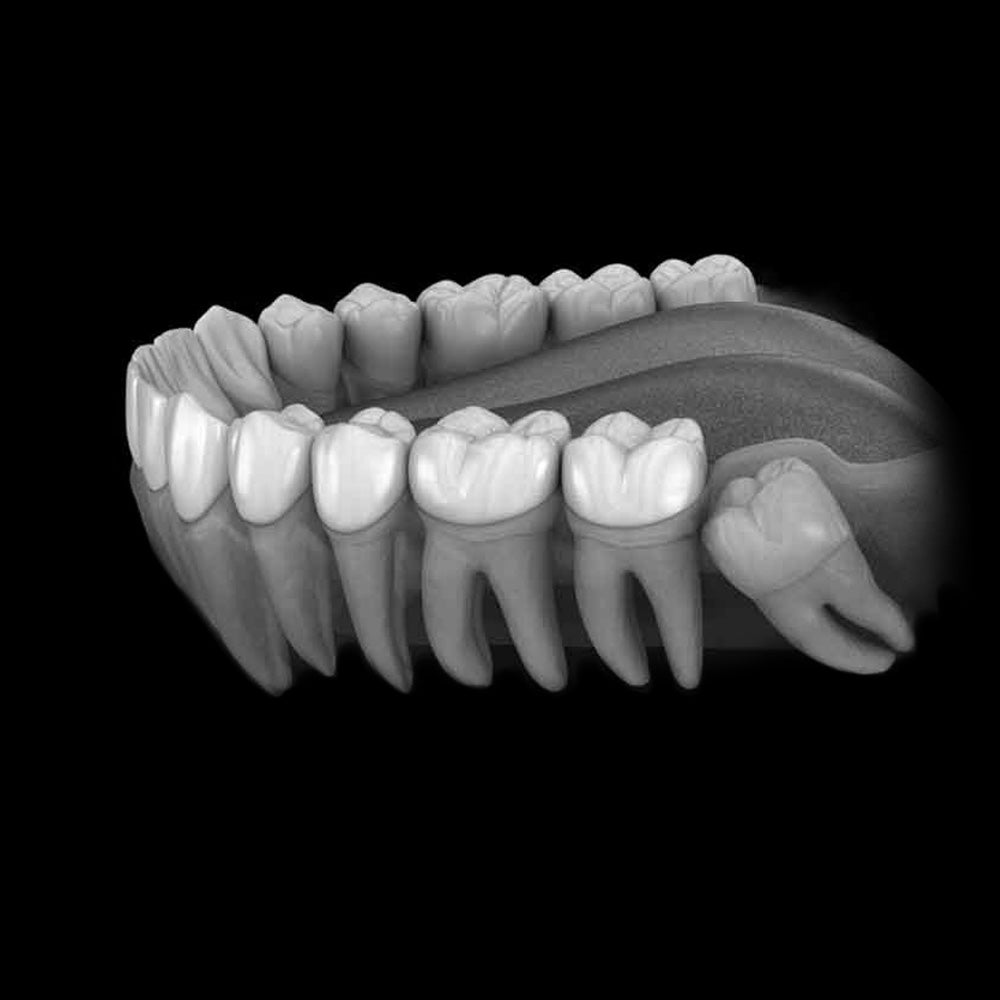 [May 3] Fundamentals of Impacted 3rd Molar Extractions