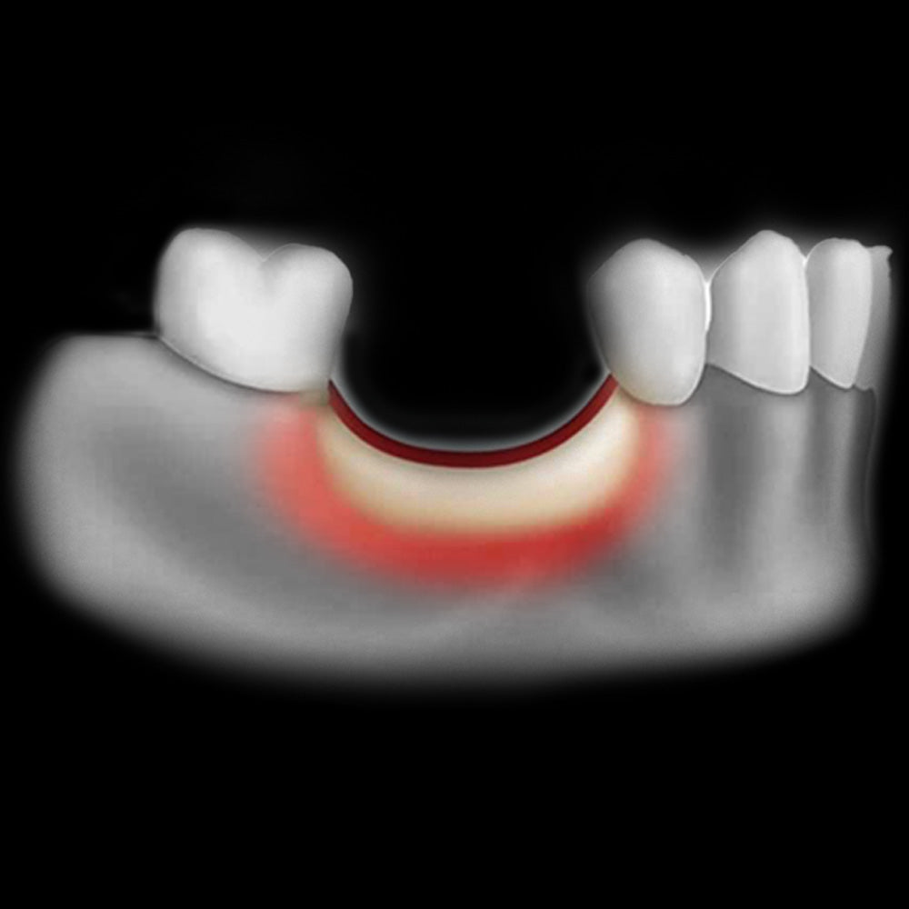 [May 17] 351-Predictable Treatment Option for Narrow Alveolar Ridge